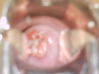 Natural cervicitis tratamiento cronica moderada